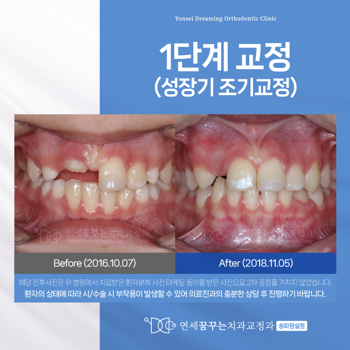 잠실치아교정 성장기 조기진단 필요할 때