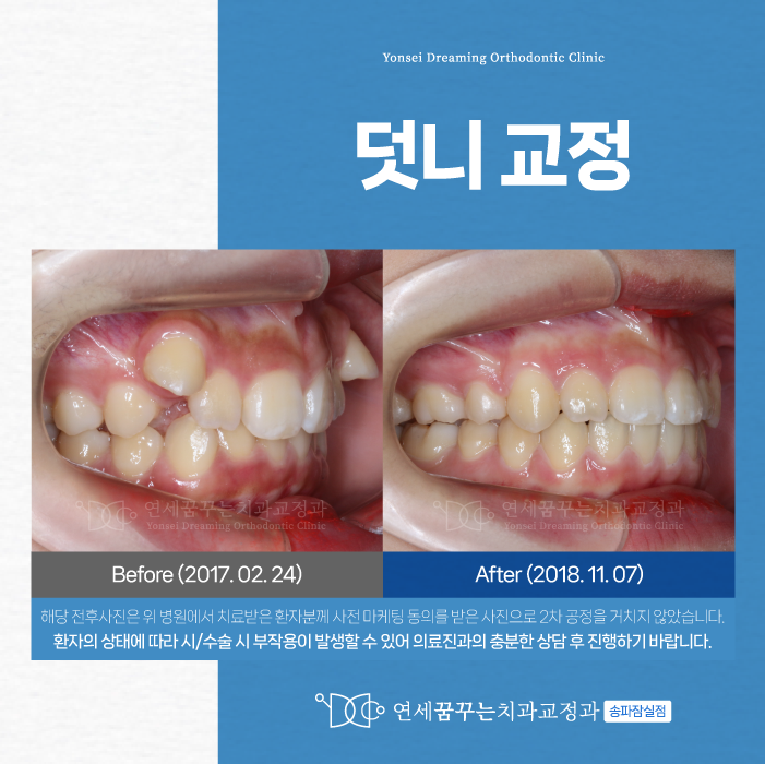 송파나루역치과 덧니교정, 가지런한 치열을 위한다면