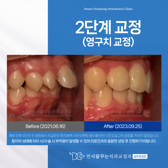 잠실교정치과 2단계 교정, 너무 늦지 않게 시작해야 하는 이유