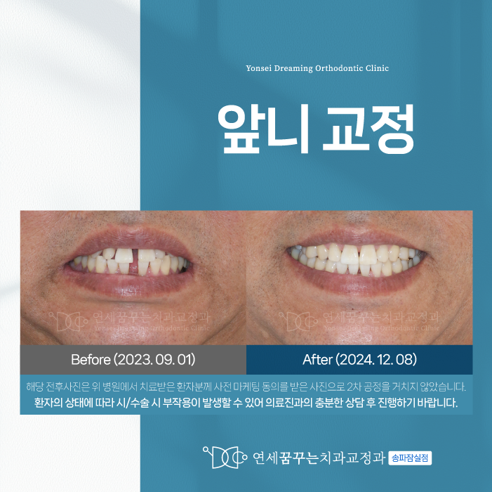 석촌역치과 앞니 교정, 고민되시나요?