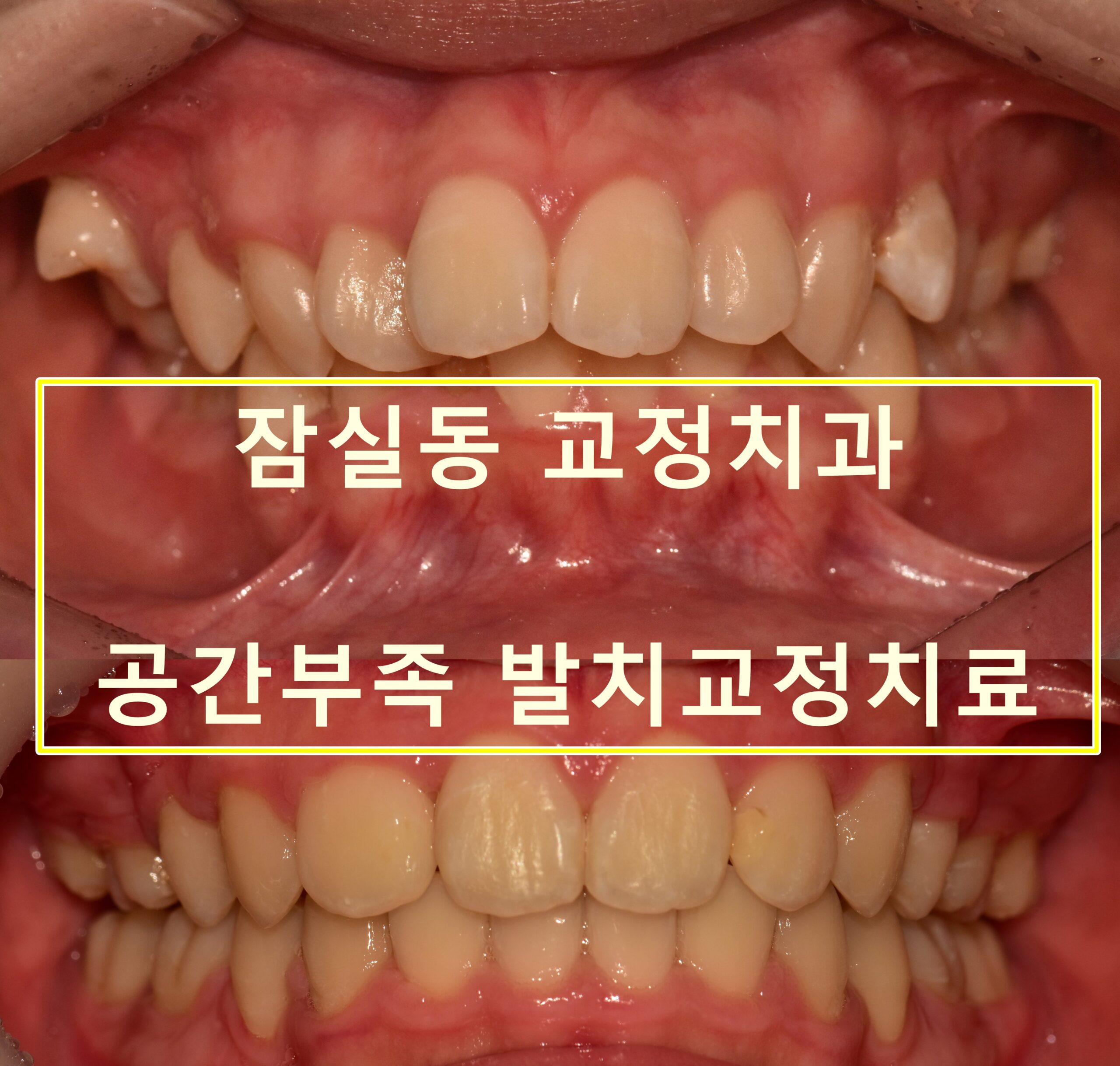 잠실동 교정치과, 아이가 이가 많이 삐뚤어요 (feat. 치과공포증, II차 교정)