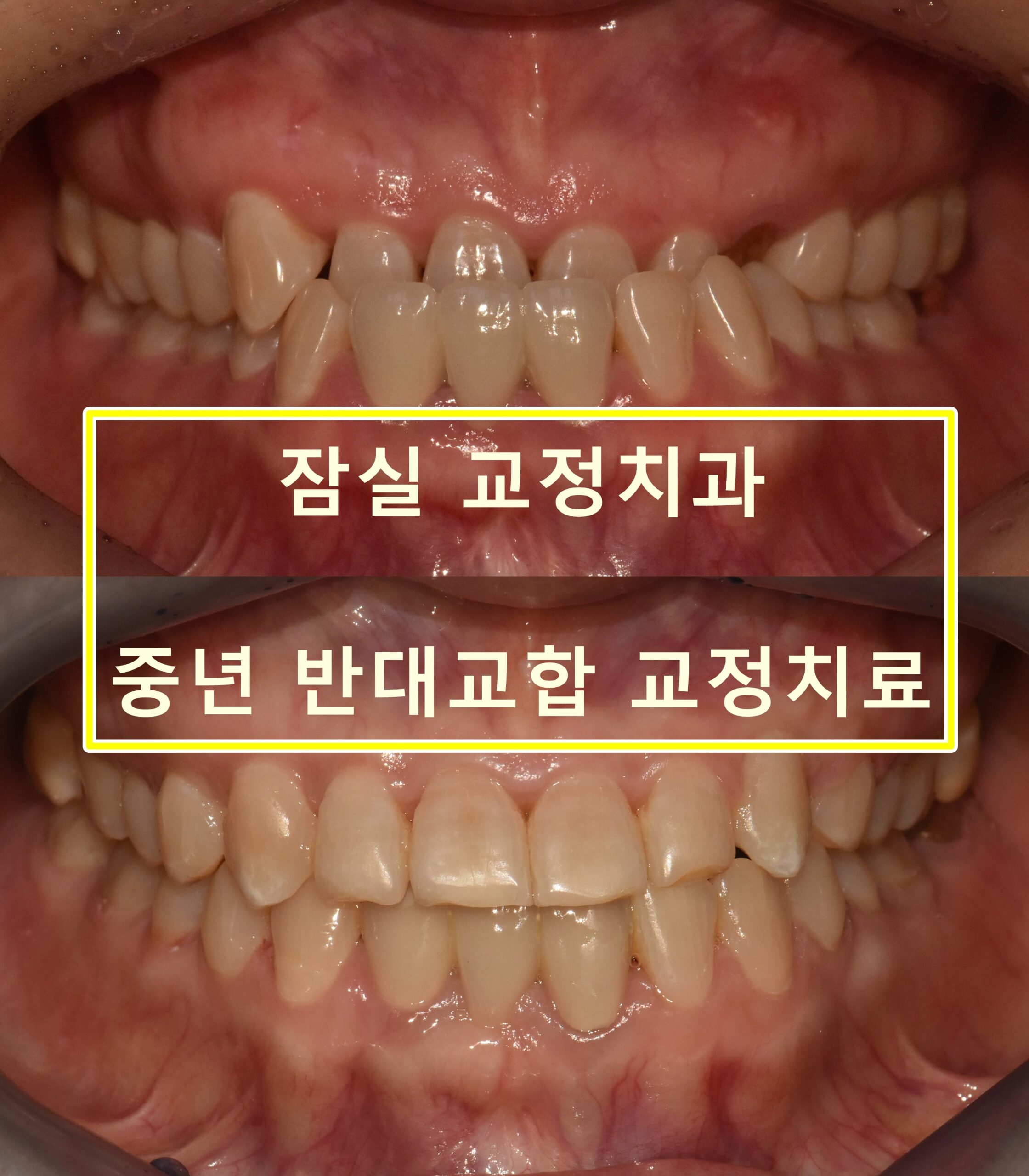 잠실 교정치과, 중년 앞니가 거꾸로 물려요 (feat. 매복치)