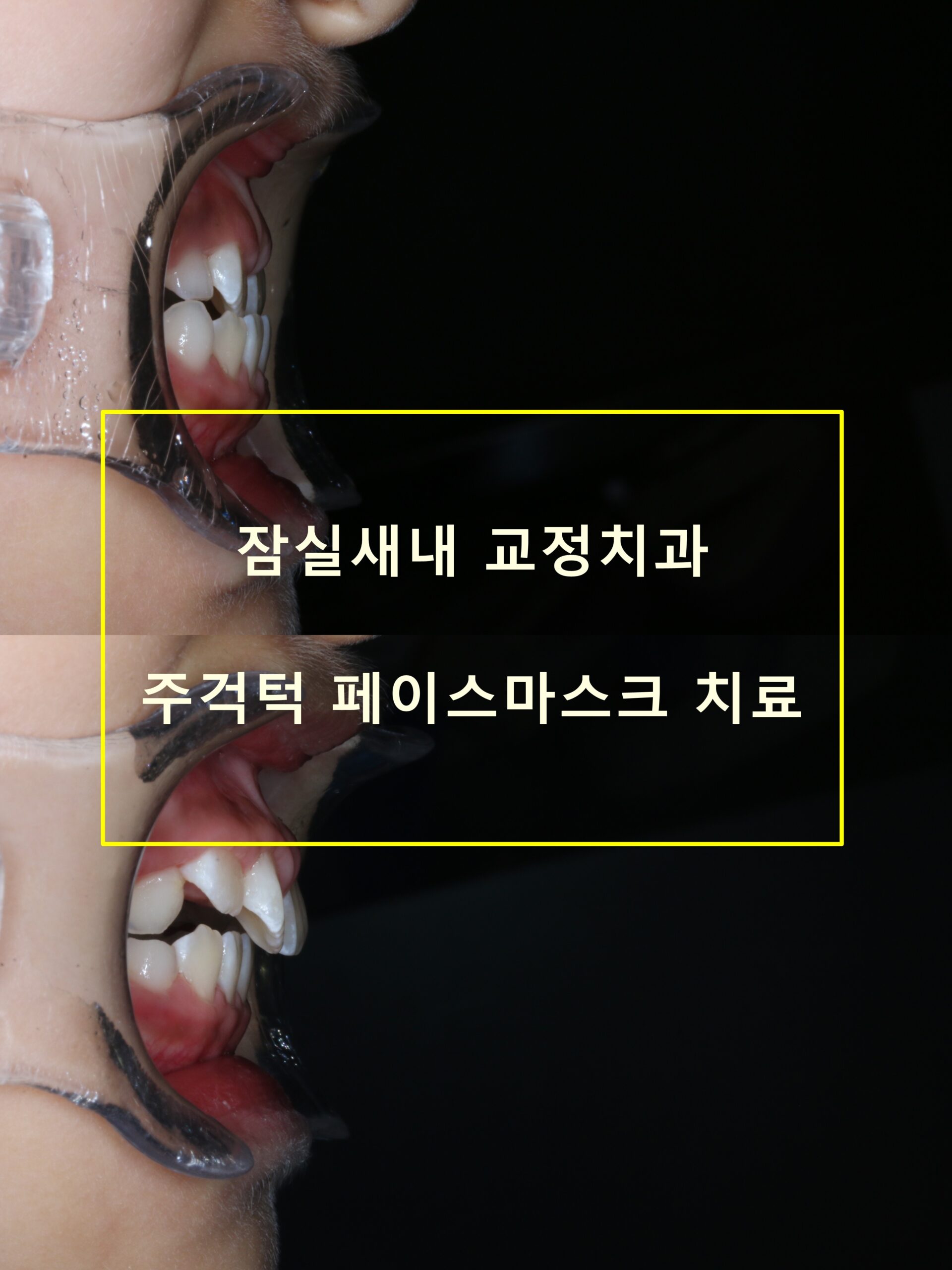 잠실새내 교정치과 우리아이 앞니가 거꾸로 물려요(feat. 1차 교정)
