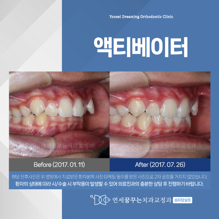 잠실교정치과 액티베이터, 턱 성장 문제 개선하는 방법