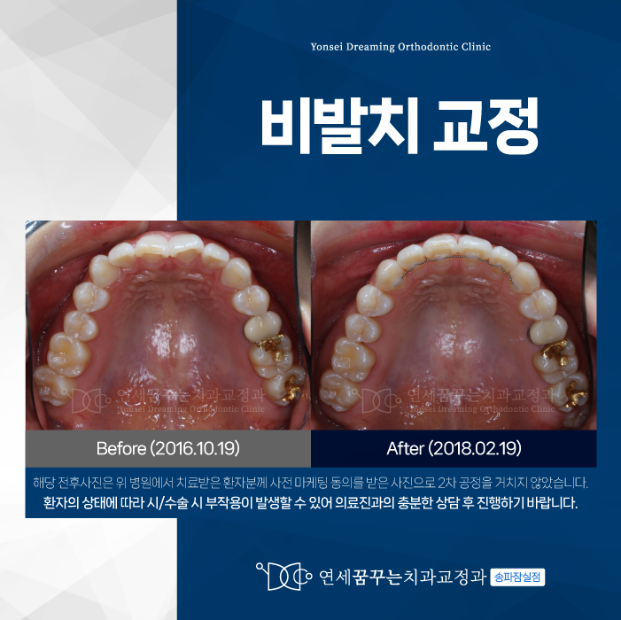 잠실치과 비발치교정 시작 전 꼭 알아야 할 것들
