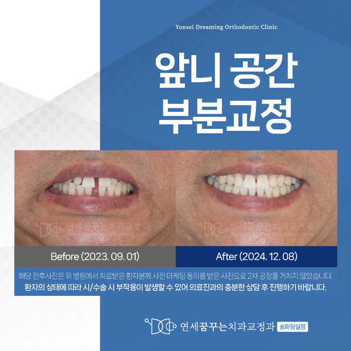 송파역치과 앞니 공간 부분교정이 궁금하다면