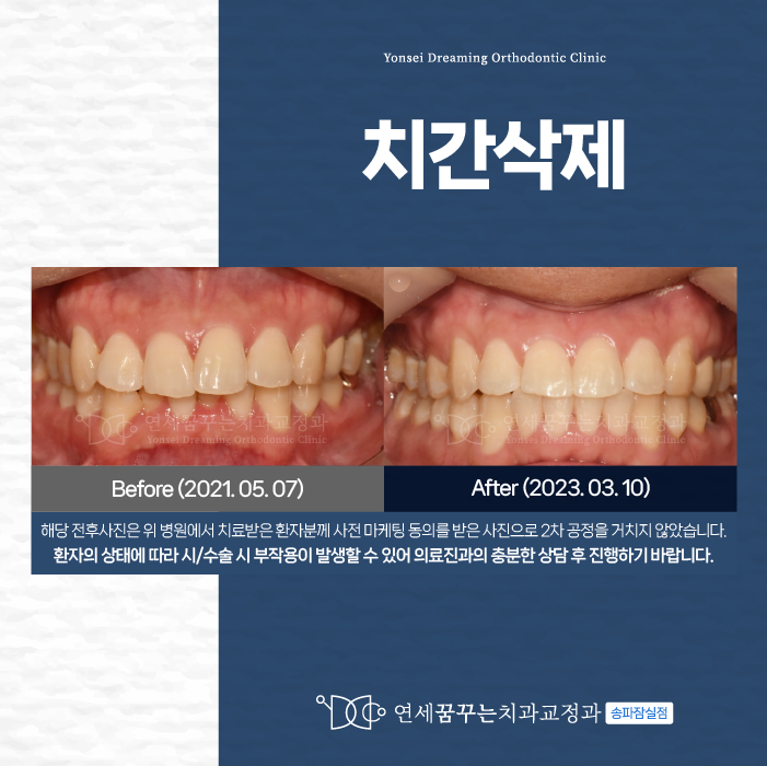 잠실치과 발치없이 가능할까? 치간삭제교정 A to Z