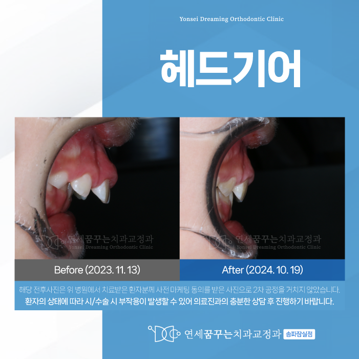방이동치과 헤드기어, 성장기 턱 균형을 맞추는 방법