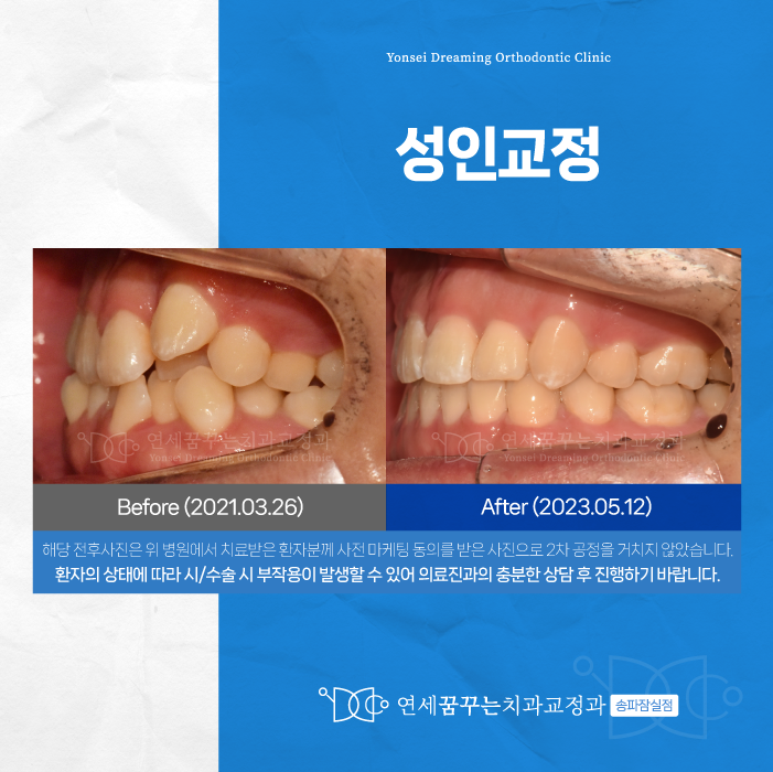 잠실교정치과 성인교정 지금 시작해도 늦지 않았습니다