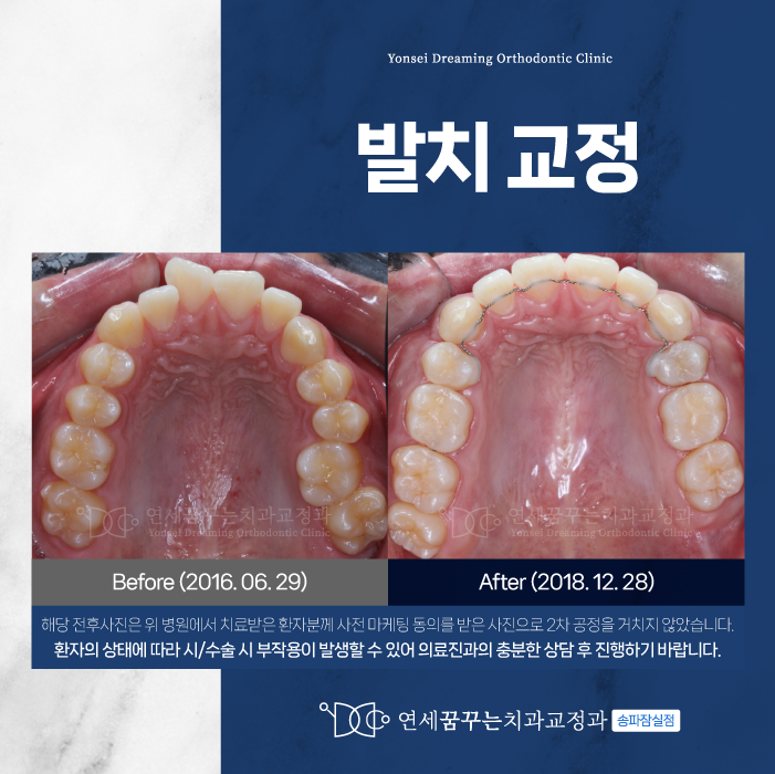 잠실동치과 발치 교정, 장점과 고려해야 할 점은?