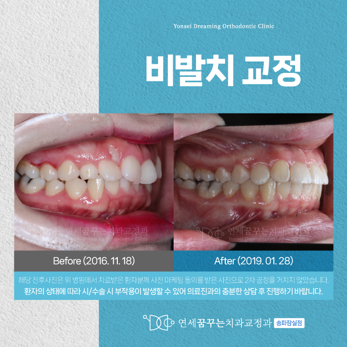 잠실새내역 치과 발치 부담 줄이고 시작하는 방법