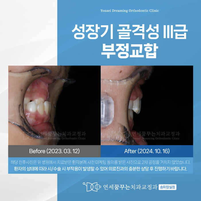 삼전역치과 성장기 부정교합 교정, 어떻게 이루어질까