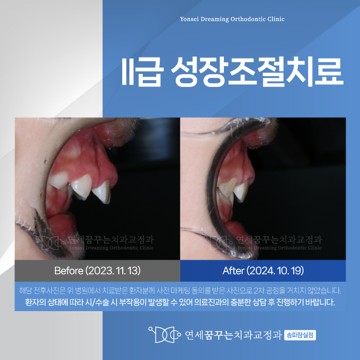 잠실역치과 성장조절치료는 아이에게 어떤 도움이 될까?