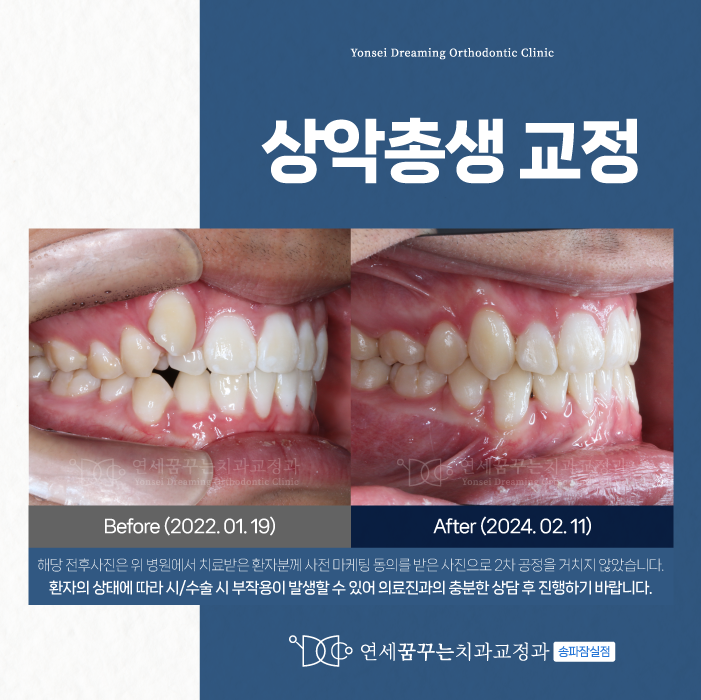 잠실교정치과 상악총생 과정이 궁금하다면