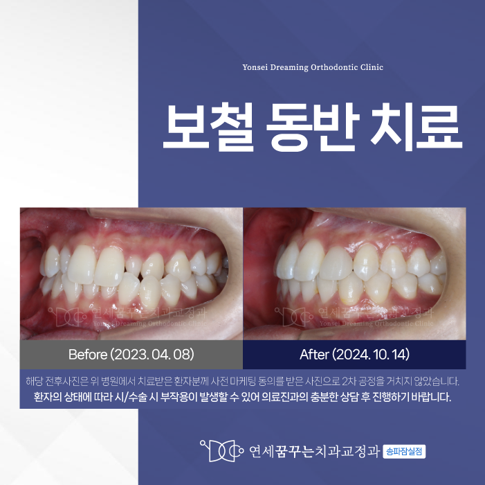잠실동치과 치열과 심미 개선을 함께 고려한다면
