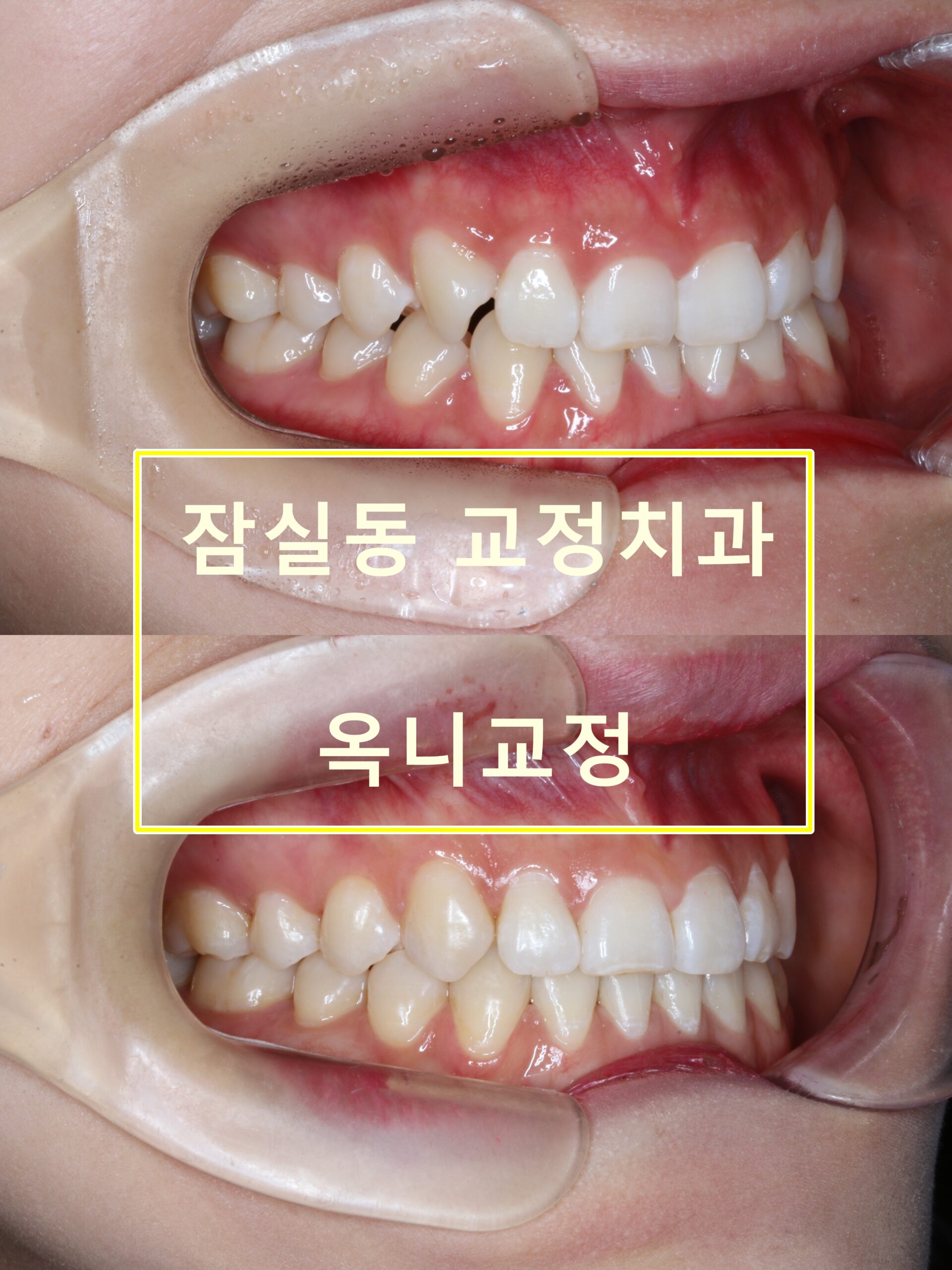 잠실동 교정치과 옥니를 개선하고 싶어요(feat. 앵글 부정교합)