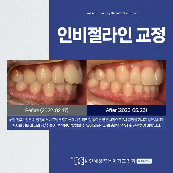 송파구치과 인비절라인 교정이 궁금한 분들께