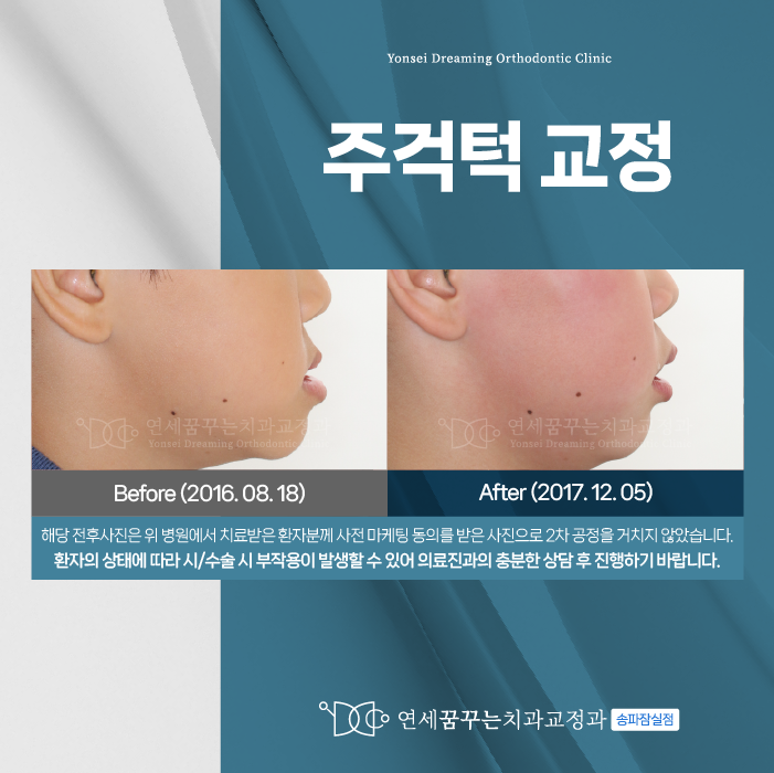 잠실교정치과 아이 턱이 나와 보인다면? 타이밍 확인하세요