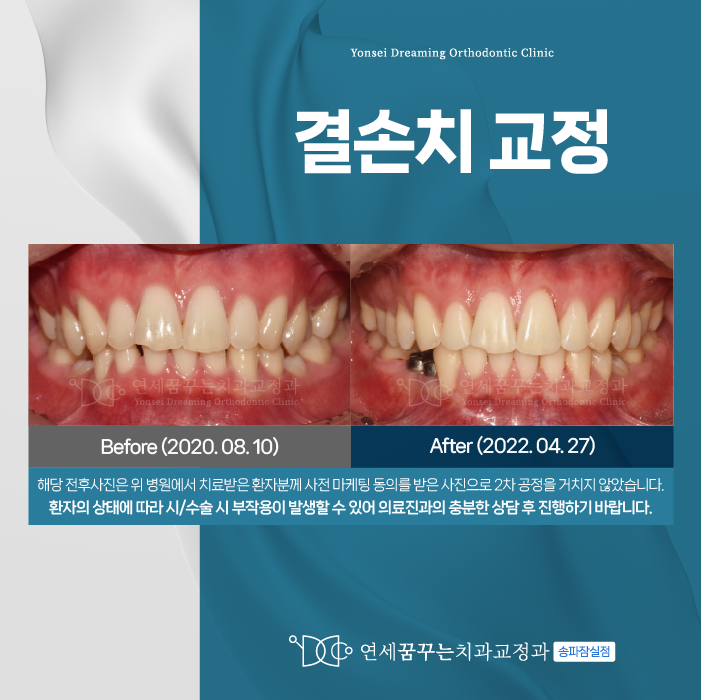 잠실치과 어릴 때 치아가 안 나왔다면? 결손치교정 체크포인트