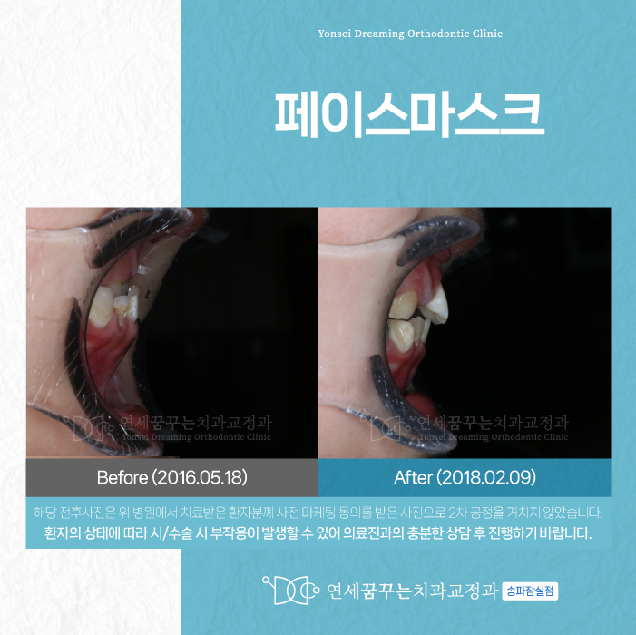석촌동 치과 페이스마스크, 언제 시작해야 할까?