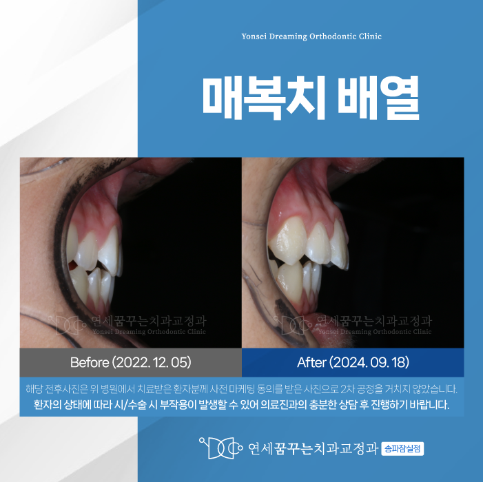 삼전동치과 매복치 교정, 조기에 점검해야 하는 이유