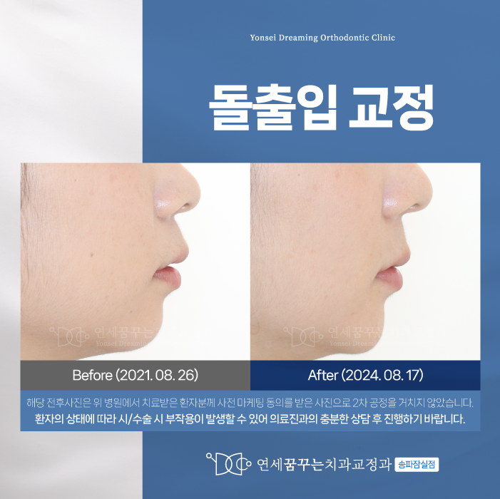 삼전동치과 돌출입교정 시 알아야 할 점은?