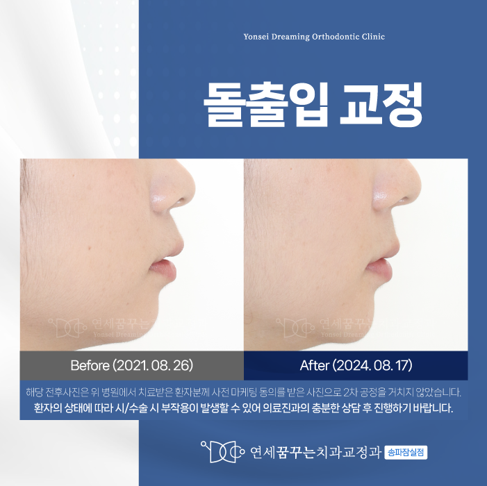 송파구치과 돌출입교정 후 어떻게 달라질까?