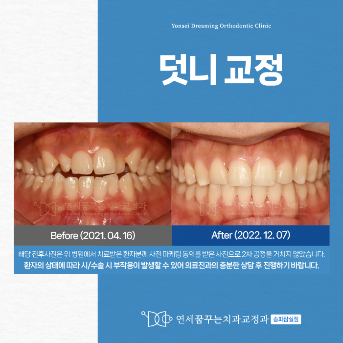 풍납동치과 덧니교정 언제 시작할까 궁금하다면