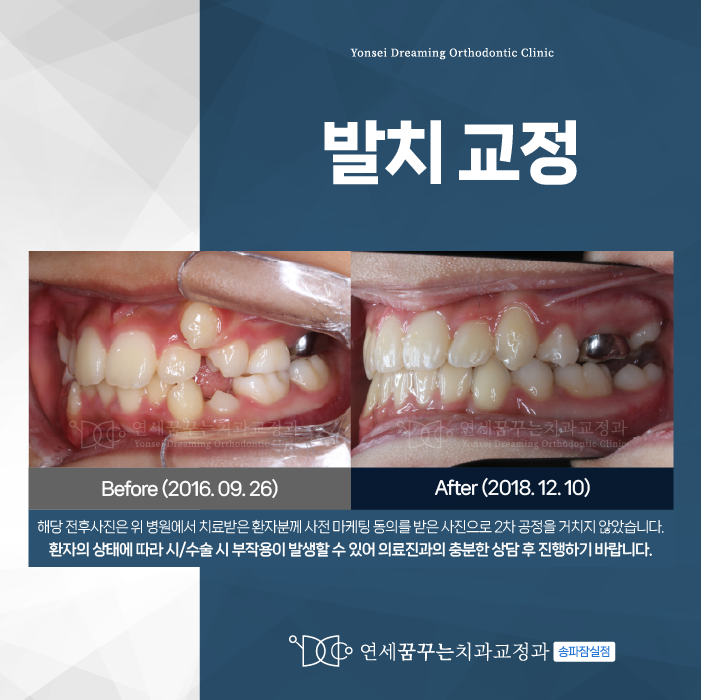 개롱역치과 발치교정 전 고민된다면