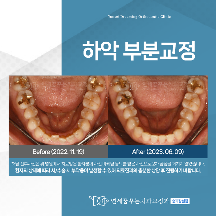 잠실교정치과 웃을 때 아랫니 신경 쓰인다면? 확인해보세요