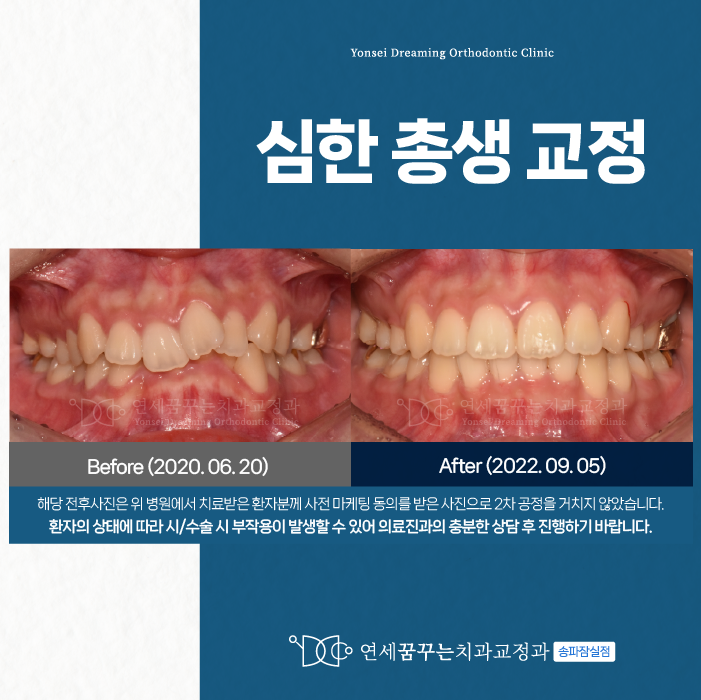 방이역치과 총생교정 언제 시작할까?