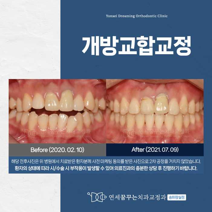 가락시장역치과 개방교합교정, 꼭 해야 할까? 궁금할 땐 이 글부터