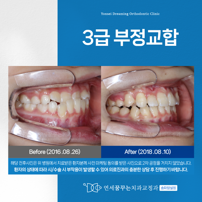 가락시장역치과 치아교정, 3급 부정교합이 고민이라면