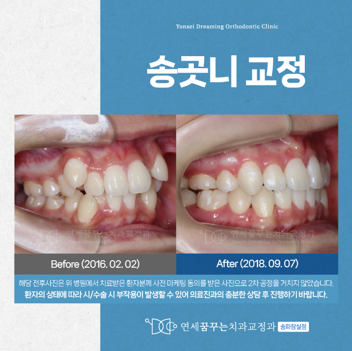 잠실새내치과 송곳니교정, 상담으로 시작해야 하는 이유